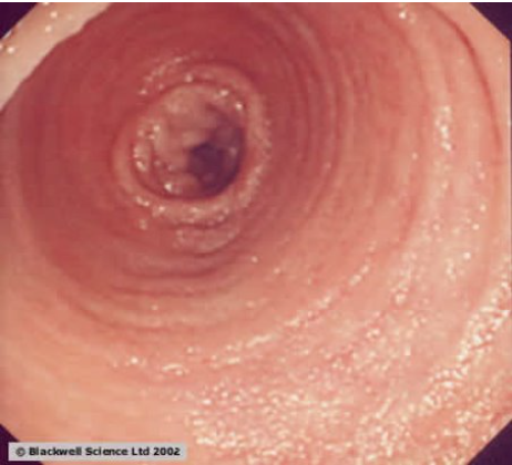 <ul><li><p>Absorption of vit B12</p></li><li><p>Has vili and less prominent plicae</p></li><li><p>Has peyer’s patches (MALT) to protect from bacteria in large intestine</p></li></ul><p></p>