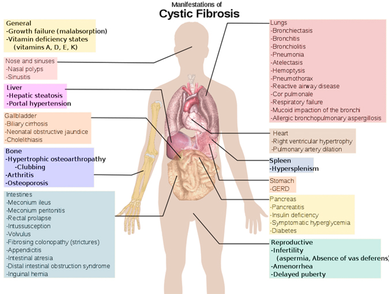 <p><span style="font-family: Arial, sans-serif;">-</span><span style="font-family: "Times New Roman"; line-height: normal; font-size: 7pt;"> </span>Occurs in a huge gene (CFTR) which is found on Chromosome 7</p><p class="MsoListParagraphCxSpMiddle"><span style="font-family: Arial, sans-serif;">-</span><span style="font-family: "Times New Roman"; line-height: normal; font-size: 7pt;"> </span>It is inherited as autosomal recessive.</p><p class="MsoListParagraphCxSpMiddle"><span style="font-family: Arial, sans-serif;">-</span><span style="font-family: "Times New Roman"; line-height: normal; font-size: 7pt;"> </span>Over 500 different recessive mutations of the CFTR gene have been identified including deletions, missense, nonsense, terminator codon.</p><p class="MsoListParagraphCxSpMiddle"><span style="font-family: Arial, sans-serif;">-</span><span style="font-family: "Times New Roman"; line-height: normal; font-size: 7pt;"> </span>The gene has the code for 1480 amino acids that make up a protein that regulates the passage of chloride ions across the cell membrane.</p><p class="MsoListParagraphCxSpMiddle"><span style="font-family: Arial, sans-serif;">-</span><span style="font-family: "Times New Roman"; line-height: normal; font-size: 7pt;"> </span>Secretions dry because water usually follows chloride by osmosis.</p><p class="MsoListParagraphCxSpLast"><span style="font-family: Arial, sans-serif;">-</span><span style="font-family: "Times New Roman"; line-height: normal; font-size: 7pt;"> </span>Common in Caucasians (1 in 26 carriers) – more resistant to cholera check. </p>