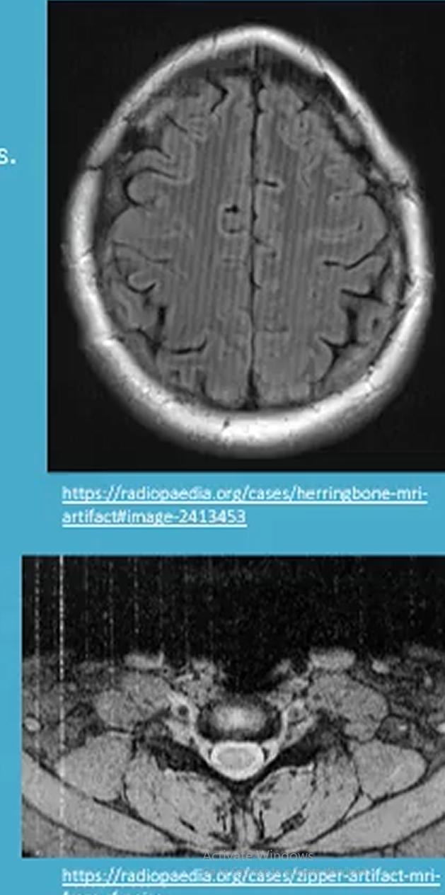 <p>RF noise artifact appears as static on the image. Occurs die to electromagnetic interference from external sources such as nearby electrical equipment. A specific RF noise is herringbone artifact.</p><p></p><p>Resolved by:</p><ul><li><p>Shielding external sources of EMI</p></li><li><p>keeping scanner room door closed</p></li></ul><p></p>