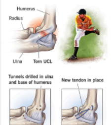 <p>A sprain or tear of the ulnar collateral ligament on the medial side of the elbow</p><p>Can also present a tingling sensation along the ulnar nerve distribution in the hand</p><p>Can be torn especially during elbow-joint dislocation or other sport injuries</p>