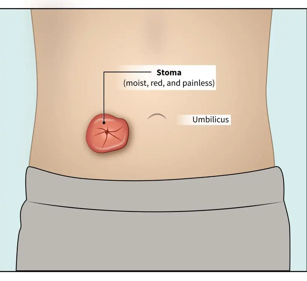 <p>A stoma is a…</p>
