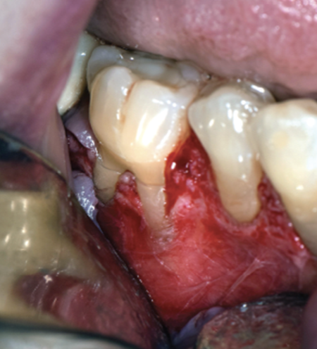 <p><span>2. Partial Thickness Flap:</span></p>