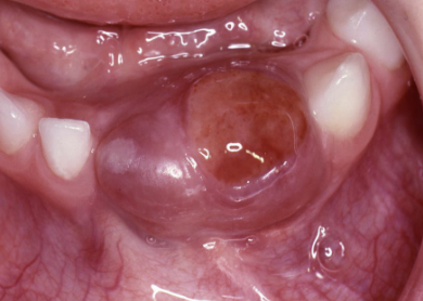 <p>anterior jaw; frequently crosses the midline, expansile </p>