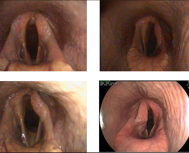 <ul><li><p>N. Laríngico Recurrente (discurre lado izq del cuello)</p><ul><li><p>atrofia neurogenica de la musculatura laringea en el m cricoaritenoideo dorsal</p></li><li><p>deficit progresivo en la abducción del cartílago aritenoides (proceso corniculado)</p></li></ul></li></ul><p></p><p>intolerancia al ejercicio</p><ul><li><p>estrechamiento de la luz (ruidos inspiratorios: roncadores)</p></li><li><p>disminuye el volumen de aire inspirado</p></li><li><p>hipoxemia → hipercapnia → acidosis metabolica → fatiga musuclar</p></li></ul><p></p><p>4 grados</p><p></p><p>pa diagnosicar haces slap test o endoscopia estatica/dinamica</p>