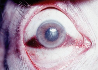 <p>Questions</p><ol><li><p>What postmortem change is characterized by the description provided?</p></li><li><p>What is the cause of this specific ocular postmortem change?</p></li></ol><div data-type="horizontalRule"><hr></div><p></p><p></p>