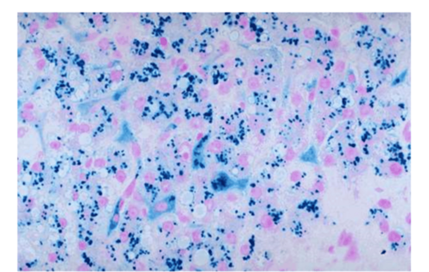 <p>Hemosiderin</p>