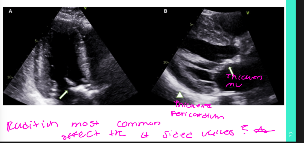 <ul><li><p>Reduced cardiac mass</p></li><li><p>Decreased LV dimensions</p></li><li><p>Reduced wall thickness</p></li><li><p>Decreased LV function</p></li><li><p>Diastolic dysfunction</p></li><li><p>Myocardial interstitial fibrosis, especially in the RV (echognic)</p></li><li><p>Valvular fibrosis - radiation most commonly affects the Left sided valves</p></li></ul><p></p><p><strong>Myocardial interstitial fibrosis</strong> means <strong>scar tissue forms between the heart muscle cells</strong>.This scarring makes the right ventricle <strong>stiff</strong>, so it cannot relax and fill with blood normally. <strong>Myocardial interstitial fibrosis</strong> means <strong>scar tissue forms in the spaces between the heart muscle cells</strong>.</p>