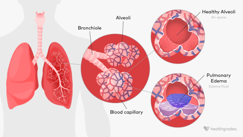 <p>interstitial tissues <strong>not draining back</strong> into capillaries &amp; post capillary venules normally → <strong>swelling</strong> in lungs (<strong>alveoli</strong>:<strong> </strong>air sacs) due to <strong>excess fluid accumulation</strong></p><p>similar to edema in systemic tissue</p><p>etiology:</p><ul><li><p>injury, infection, heart failure, liver/kidney disease, medication, pregnancy</p></li></ul><p>treatment:</p><ul><li><p>elevation, garments, medicine, activity</p></li></ul><p></p>