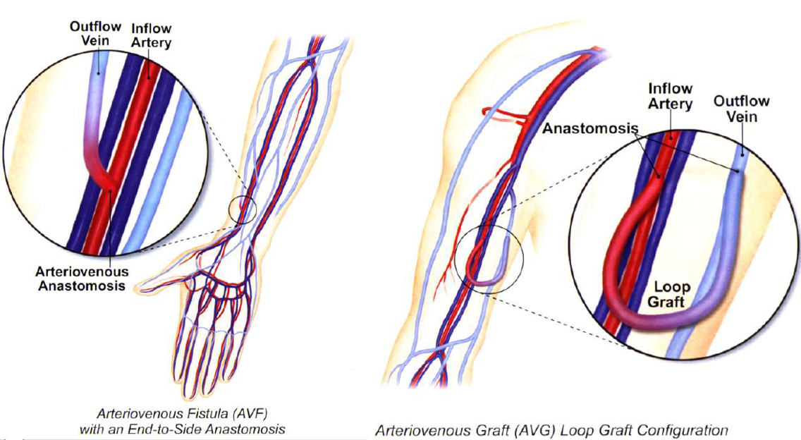 <p> forearm and upper arm : loop or straight</p><p>thigh grafts : loop </p>