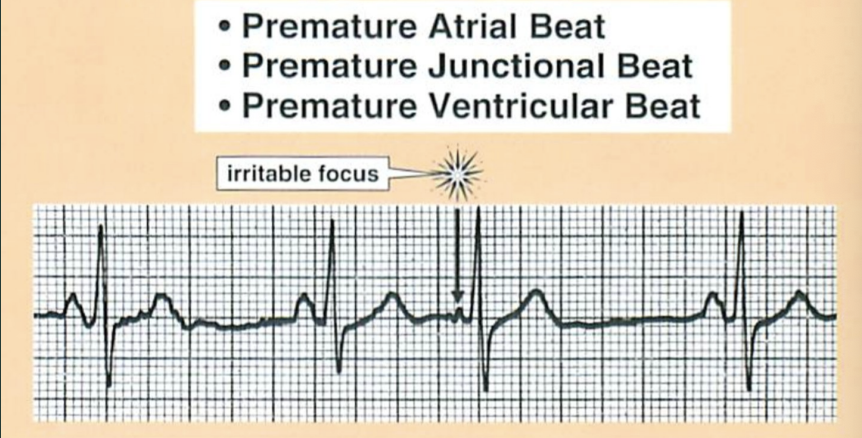 <p>What’s a premature beat?</p>