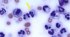 <p>What type of effusion is this?</p>