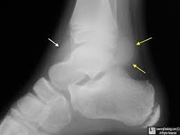 <p>build up of fluid in ankle joint</p>