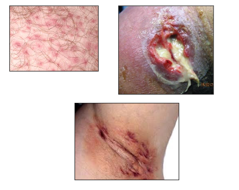 <p>- Frequent cause of skin infections</p><p>.</p><p>- Folliculitis</p><p>- Furuncles (boils)</p><p>- Carbuncles</p><p>- Impetigo</p><p>- Cellulitis</p><p>- Wound Infections</p>