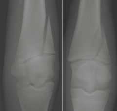 <p>What is this type 3rd metacarpal (cannon) bone fracture? Who commonly gets it?</p>