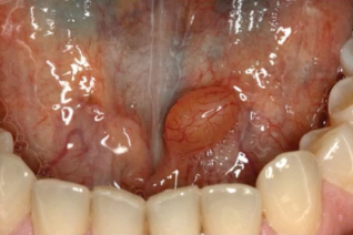 <p>epithelial lined cavity in ADULTS, more commonly found on UPPER LIP but can occur in FOM</p>