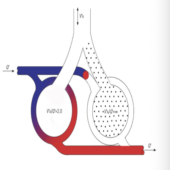 <p>hoge V/Q verhouding</p><p>= hoge P<sub>A</sub>O<sub>2 </sub>in alveoli treedt er bronchoconstrictie op —> geeft een verkleinde aanvoer van nieuwe lucht</p>