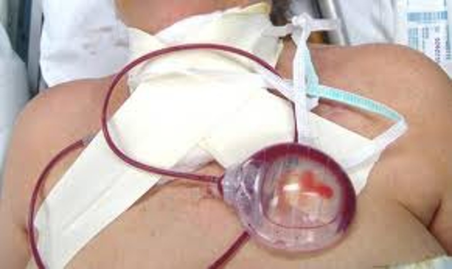 <p>tubing from surgical site of suction bulb that drains/collects fluid from surgical site</p>