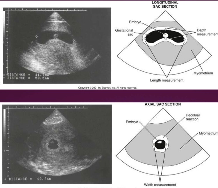 <p>Sum of length, depth, and width of gestational sac (excluding wall) divided by 3; GA (in days) is calculated by adding 30 to MSD (in millimeters); machine usually calculates this on its own</p>