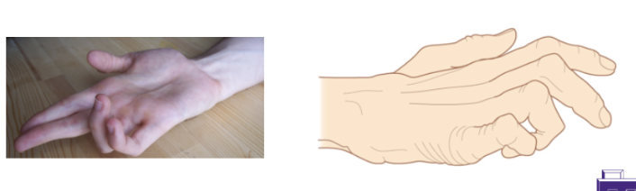 <p><strong>Ulnar Nerve Palsy (Klumpke Paralysis)</strong></p>