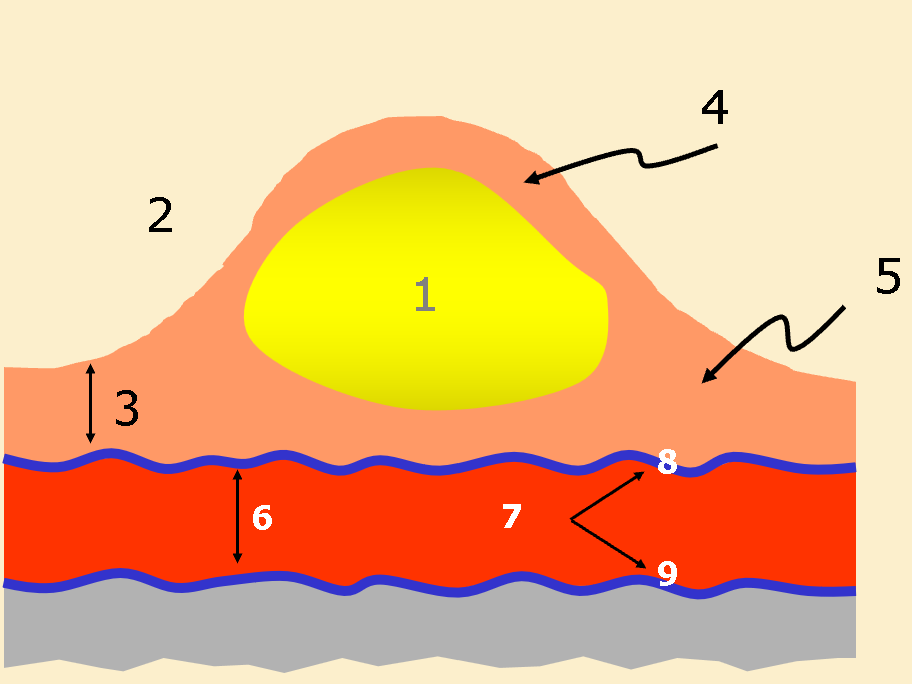 <p>Label the atherosclerotic plaque</p>