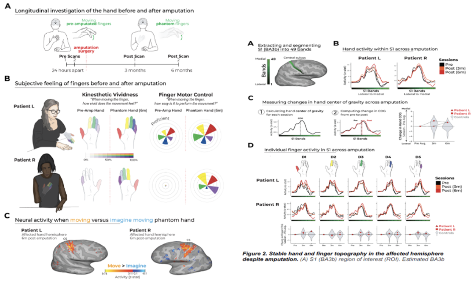 <ul><li><p><span style="background-color: transparent;">Scanning two patients before and after surgery, where they underwent amputation surgery&nbsp;</span></p><ul><li><p><span style="background-color: transparent;">Pre-scans 24 hours apart, 3 months after and 6 months after&nbsp;</span></p></li></ul></li><li><p><span style="background-color: transparent;">Collected: how they experienced the movement, how they could control different movements, and “phantom pain”&nbsp;</span></p></li><li><p><span style="background-color: transparent;">Looked into reorganisation in the somatotopic maps, e.g. fingers becoming fused, taking over body parts no longer occupied&nbsp;</span></p></li><li><p><span style="background-color: transparent;">In both patients, there is convincing evidence that there are no changes in the somatotopic maps</span></p></li></ul><p></p>