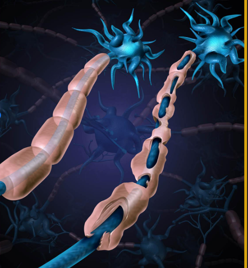 <ul><li><p><span style="background-color: transparent;">1 out of 1000 patients in the US</span></p></li><li><p><span style="background-color: transparent;">MS begins between ages 20 and 40</span></p></li><li><p><span style="background-color: transparent;">An autoimmune disease (the body’s defense system attacks the myelin sheath.)</span></p></li><li><p><span style="background-color: transparent;">Slow transmission of impulse in the affected neurons</span></p></li></ul><p></p>