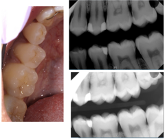 <p>What is the treatment for #19?</p><p>Findings:</p><p>- Visual: O- Initial</p><p>- Visual: D Shadowing, Microcav.</p><p>- Radiographic: D-Moderate</p>