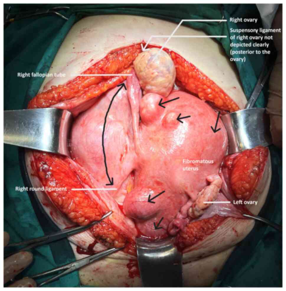 <p>leiomyoma appearance*</p>