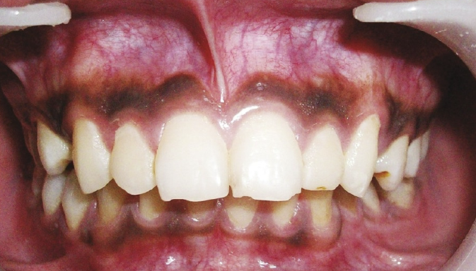 <p>most commonly observed in patients of color, variant of normal</p>