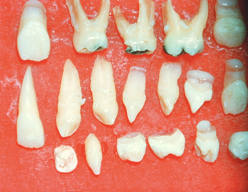 <p><span>Cleidocranial Dysplasia</span></p>