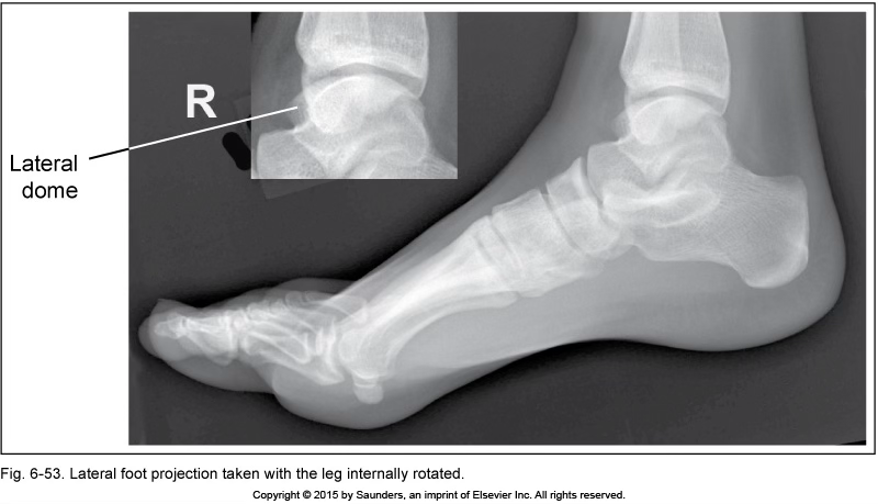 <p>lateral foot</p>