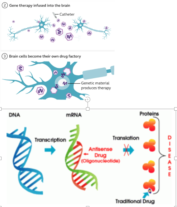 <p>antisense oligonucleotide - gene silencing via antisense drug binding DNA stopping translation</p><p>uniQure- virus containing specially designed seq of DNA, virus infused into brain using RT-MRI to guide a microcatheter to Caudate nucleus &amp; putamen (12-18hr surgery) -> cells produce miDNA designed to intercept &amp; disable mRNA for mHTT (=lower lvl mHTT)</p>