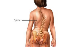 <p>A sideways curvature of the spine often diagnosed during adolescence.</p>