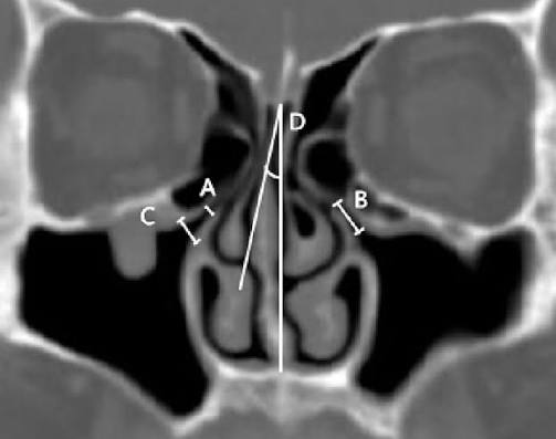 <p>which sinus is this?</p>