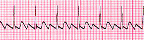<p>what does this EKG show? </p>