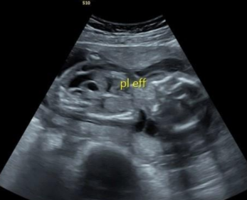 <ul><li><p><span style="background-color: transparent;">Abnormal amount of fluid build up in 2+ areas of the body</span></p><ul><li><p><span style="background-color: transparent;">Pericardial effusion</span></p></li><li><p><span style="background-color: transparent;">Pleural effusion</span></p></li><li><p><span style="background-color: transparent;">Ascites</span></p></li><li><p><span style="background-color: transparent;">Cystic hygroma</span></p></li><li><p><span style="background-color: transparent;">Skin edema&nbsp;</span></p></li></ul></li><li><p><span style="background-color: transparent;">Two types: immune and nonimmune</span></p></li></ul><p></p>