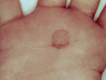 <p>tinea negra presentation</p>