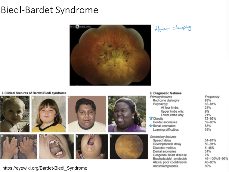 <p>A rare, inherited ciliopathy that affects multiple body systems. Pt typically present with obesity and renal anomalies. </p>