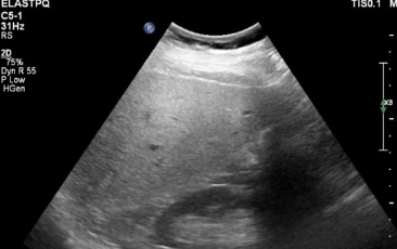 <p>Steatosis; also known as fatty liver</p><p>Alcohol and obesity are the leading cause</p>