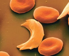 <p>Red blood cells become sickle-shaped, deformed, fragile, and break easily.</p>