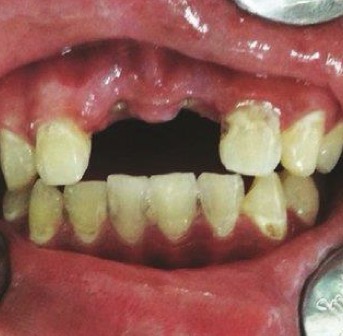 <p>1. Scaling and cleaning</p><p>2. Obturations (many caries to treat)</p><p>3. Conventional porcelain fused metal (PFM) bridge</p><p>4. Endo-osseous implant- depends on bone availability, adjacent gingival tissues, operator ability </p><p>5. Aesthetic bridges</p><p>6. Removable prosthesis</p><p>7. Auto transplantation ??</p>