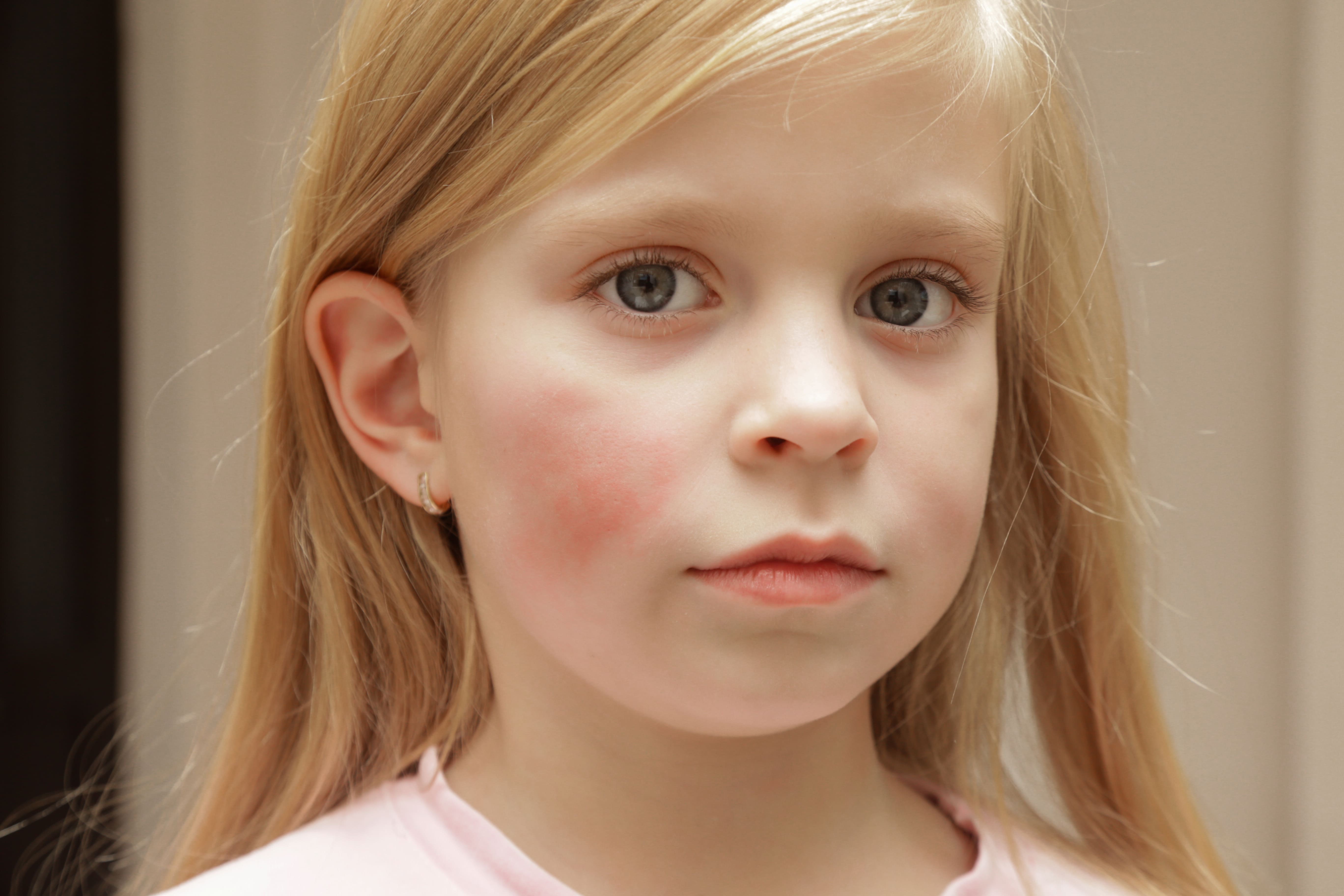 <p>Fifth disease (erythema infectiosum)</p>
