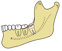 <p>more difficult</p><p>tooth partially covered by bone</p><p><span style="color: red;">requires soft tissue flap + bone removal + possible sectioning</span></p>