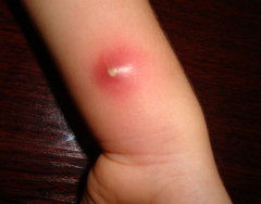 <p>fluctuant, tender, erythematous nodule, may drain spontaneously.</p>