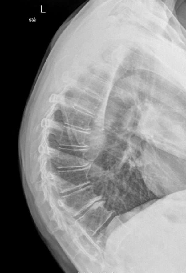 <p>AVN at the vertebral end plate epiphysis </p>