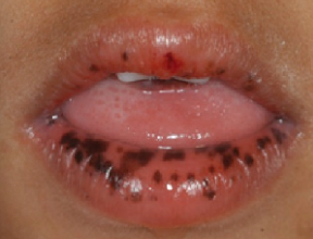 <p><span style="color: red;">buccal mucosa, gingiva, hands, feet</span></p><p>similar to ephelides (freckles) but with a<span style="color: red;"> peri-oral distribution (around the lips)</span></p>