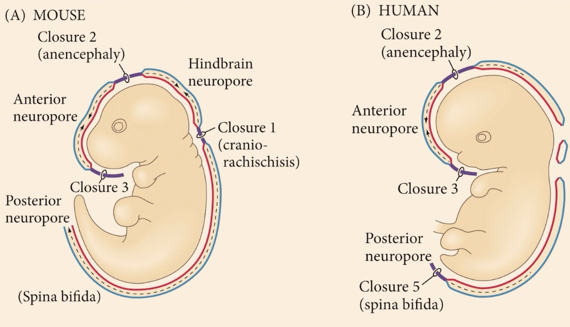 <p>What is the phenotype for a complete or partial failure to close the posterior side?</p>