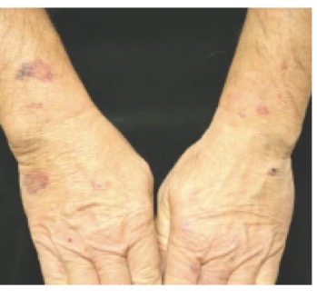<p>Ecchymosis (bruise) to dorsal forearms and hands</p><p>doesn’t extend about “shirt-sleeve” on upper arm</p>