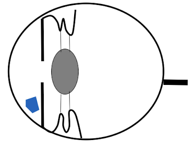 <ul><li><p>Preiridial fibrovascular membrane</p></li><li><p>Hyphema → inc blood in anterior chamber</p></li><li><p>Exudates → cellular debris</p></li><li><p>Plasmoid aqueous → too much protein, cells cannot settle</p></li></ul><p></p>