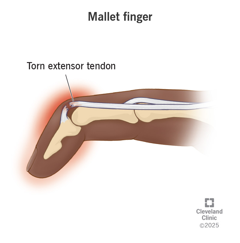 <ul><li><p><span style="background-color: transparent;">Zones I and II—mallet deformity</span></p><ul><li><p><span style="background-color: transparent;">Zone I or II may not require surgical intervention</span></p></li></ul></li><li><p><span style="background-color: transparent;">Intervention immobilized in slight hyperextension for 8 weeks—leaving PIP joint free.&nbsp;</span></p></li></ul><p></p><p></p>